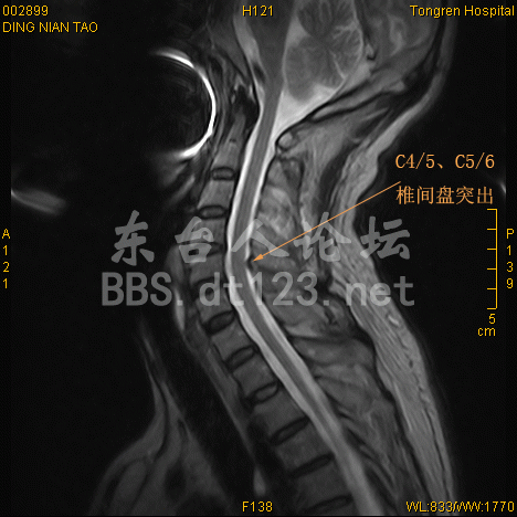 颈椎间盘突出欲北上求医,后花1000元于东台同